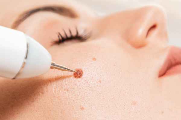 CryoPen: 5 Skin Concerns It May Be Used to Treat 3 What actually happens during a CryoPen treatment Derby?