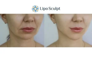 Explaining Total Skin Tightening Treatment And What It Can Do For You 2 Do you want to boost your self confidence? Give Morpheus8 Derby a try today!