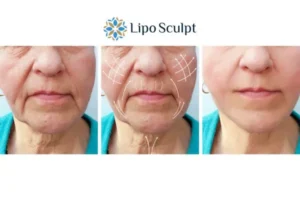 Explaining Total Skin Tightening Treatment And What It Can Do For You 3 Boost your confidence with Morpheus8 Derby call our team today!