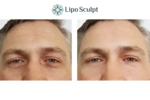 Explaining Total Skin Tightening Treatment And What It Can Do For You 6 Morpheus8 Derby book in today to find out more!
