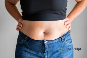 Bidding Farewell to Muffin Tops with Aqualyx Fat Injections 2 Do you wish you could reduce your muffin top Derby With Aqualy fat dissolving injections you can!