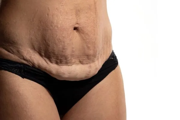 Lost the Weight but Not the Loose Skin? 1 image of womans stomach after weight loss showing loose skin Derby